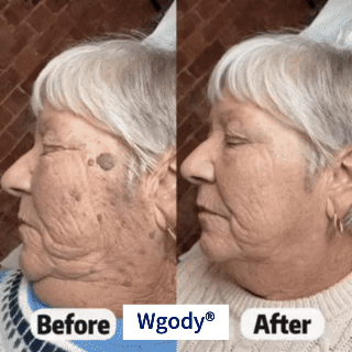 Side-by-side visual comparison of a targeted skin spot