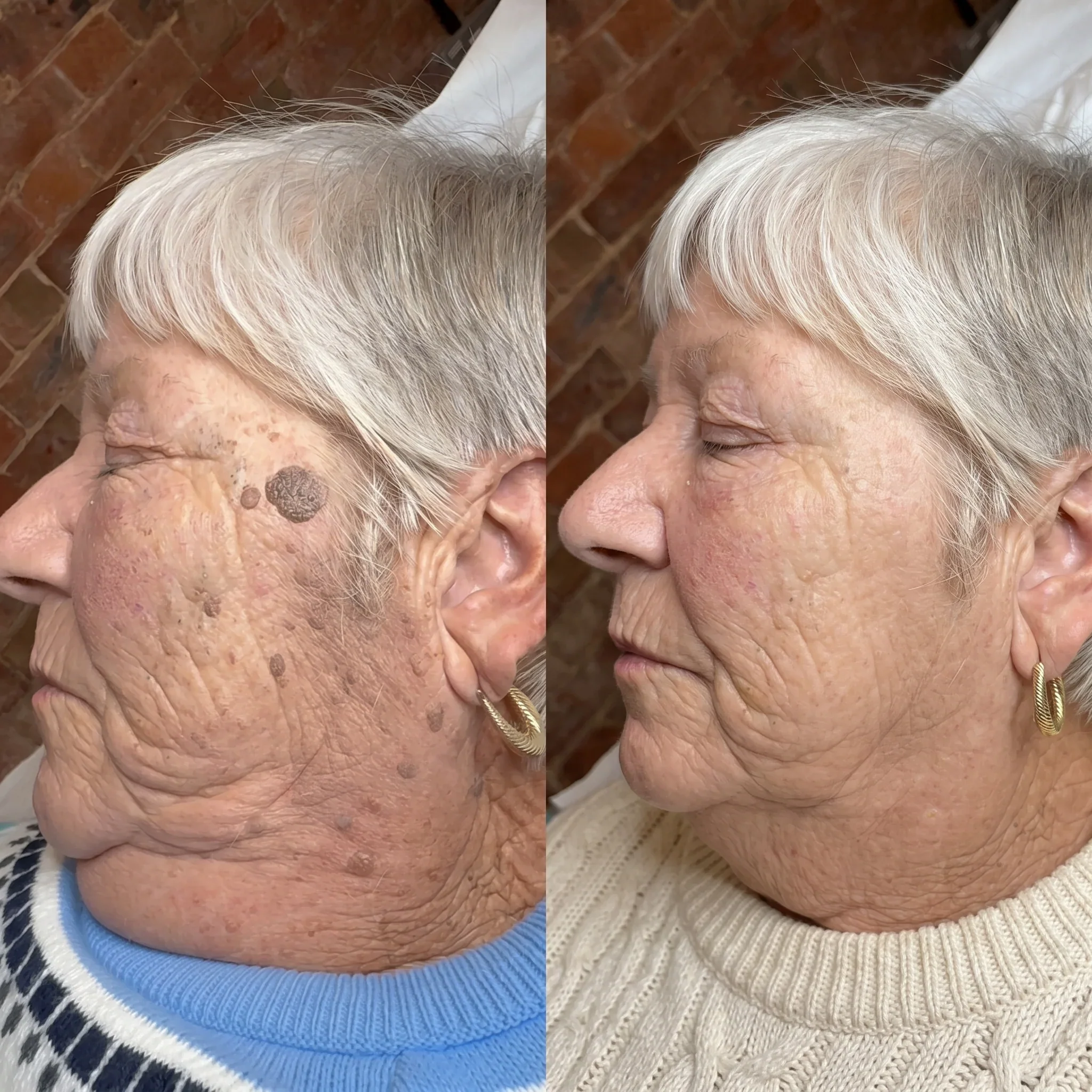 Face raised spots customer review