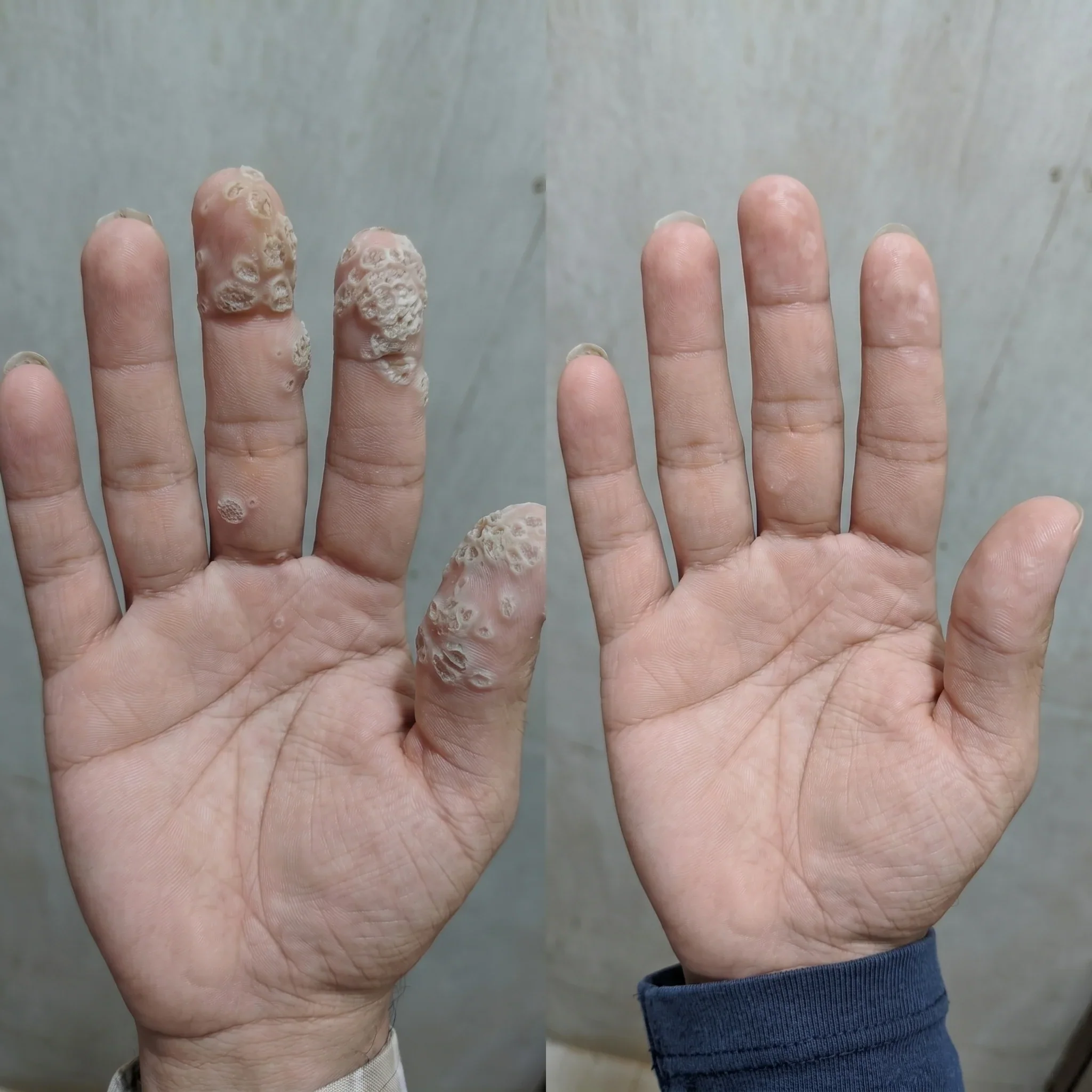 Stubborn hand warts customer review