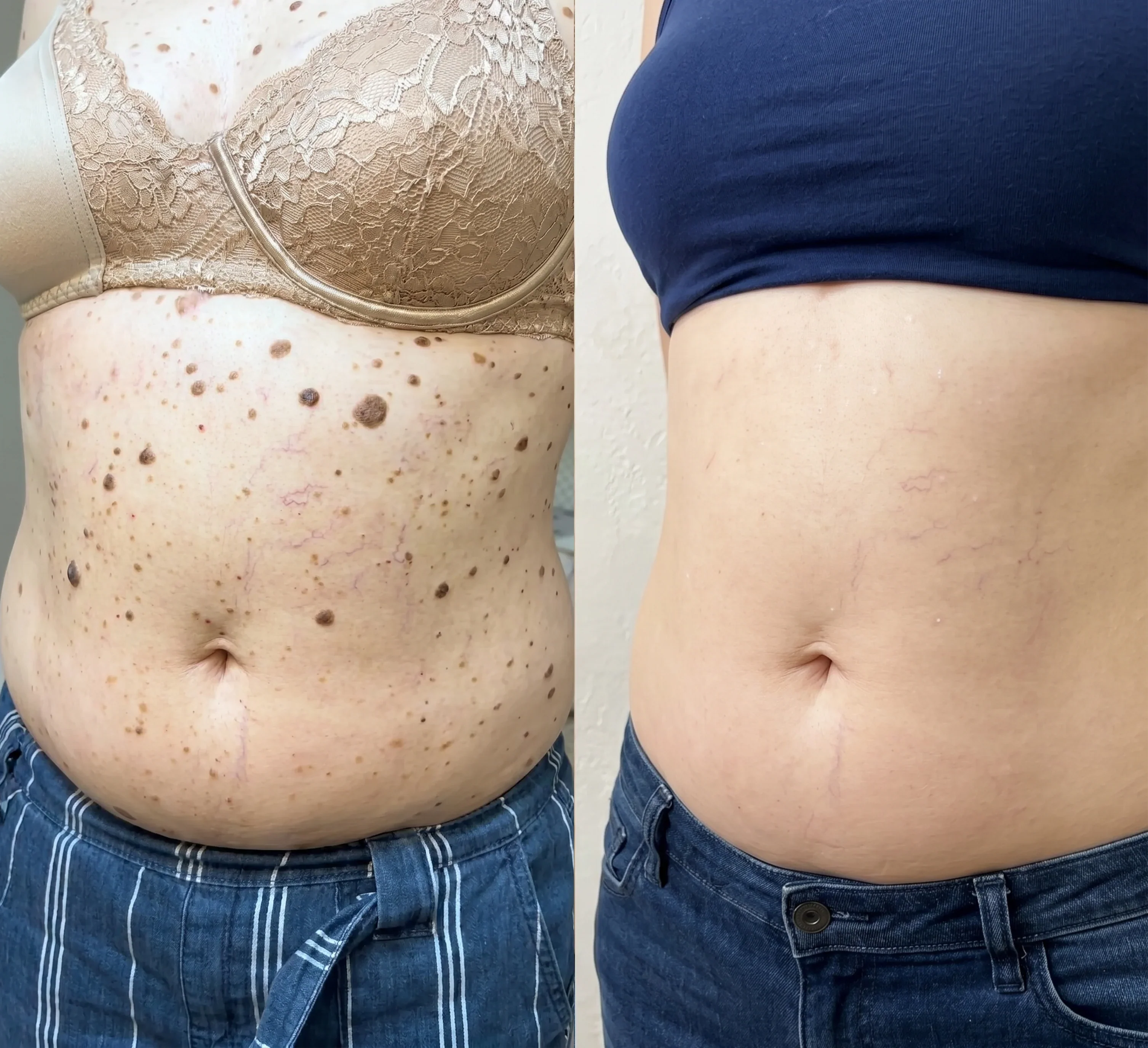 Chest and stomach raised spots customer review