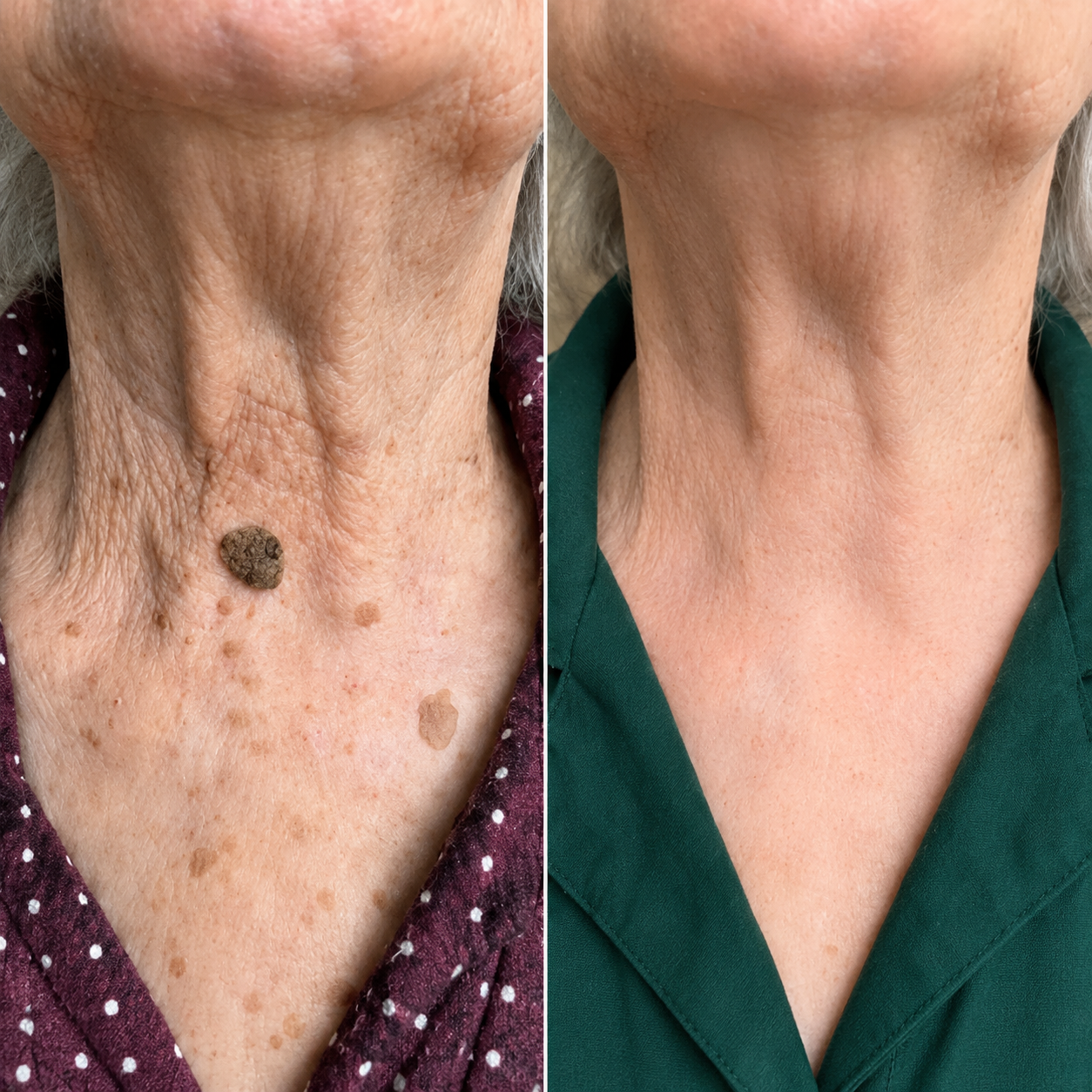 Jawline skin tag customer review